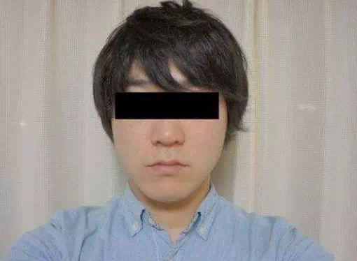 순간 접착제로 코털 뽑으려다 일어난 대참사